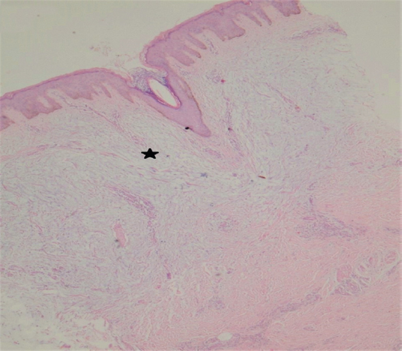 Histopathology from the plaques on haematoxylin and eosin stain (×40) showing large deposits on mucin in the reticular dermis (*), separating collagen fibres.
